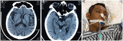 Severe Encephalatrophy and Related Disorders From Long-Term Ketamine Abuse: A Case Report and Literature Review